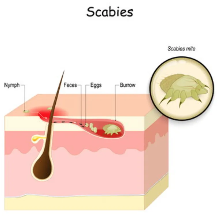 Scabies