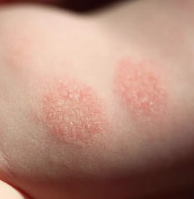 Nummular dermatitis