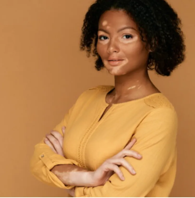 Vitiligo | Leah Michel APRN, FNP-BC
