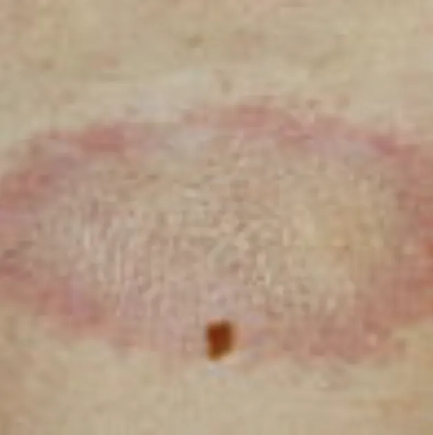 Morphea (Localized Scleroderma)