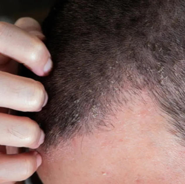 Seborrheic Dermatitis