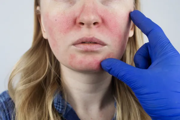 Rosacea