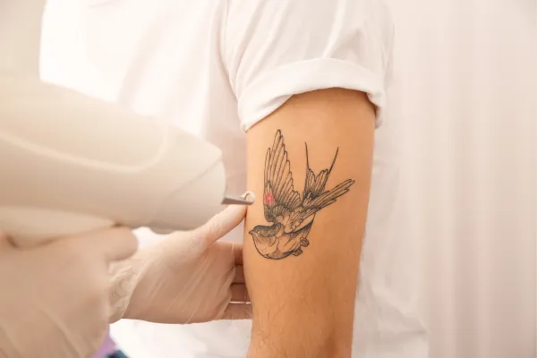 Beyond Lasers: Your Guide to Tattoo Removal | My Skin