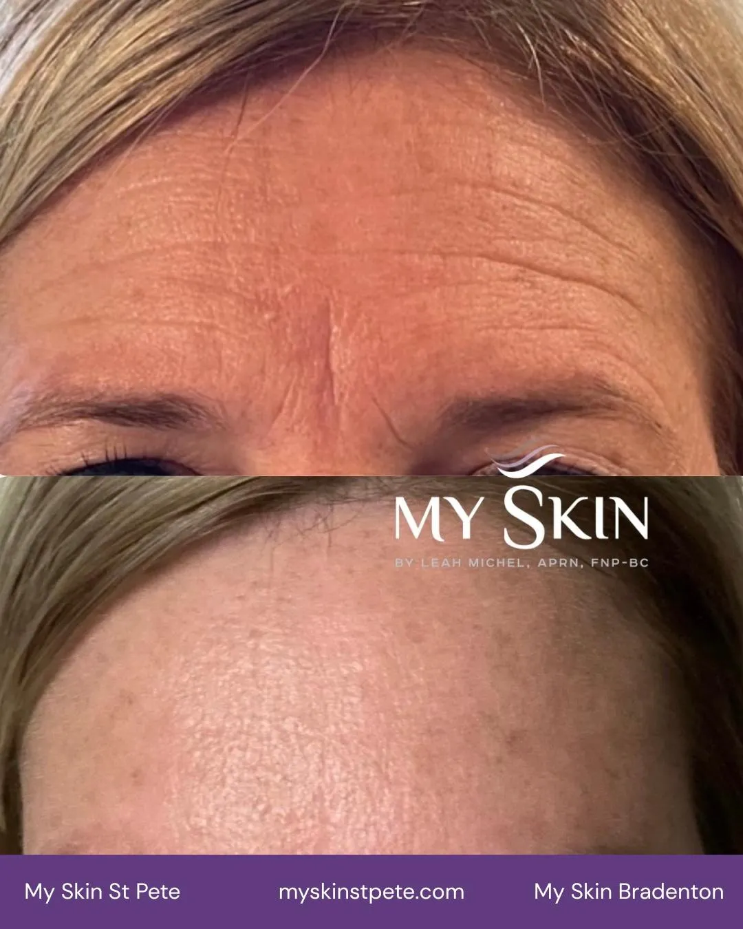 Is Botox Safe? | Leah Michel, APRN, FNP-BC