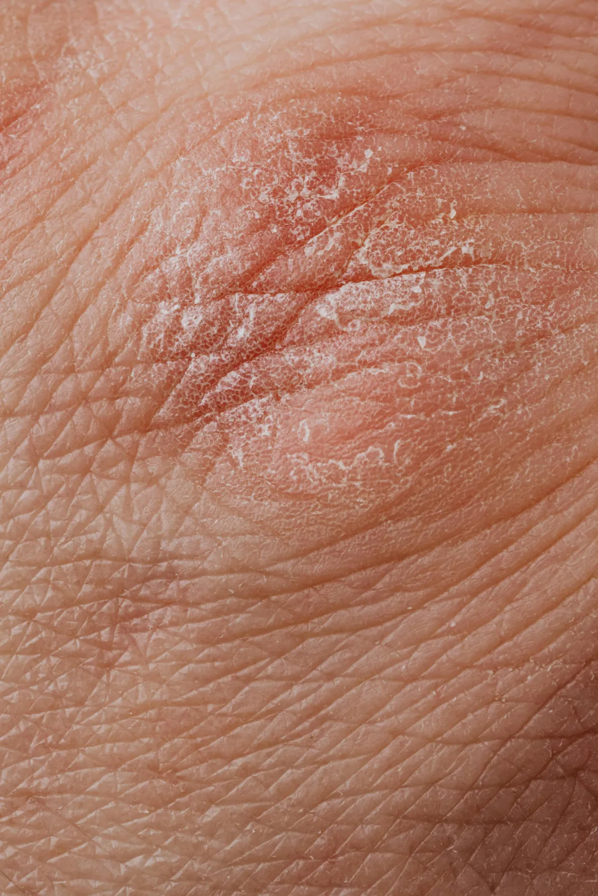 Skin Deep: Understanding Common Skin Conditions and Diseases (Part 2) | Leah Michel APRN, FNP-BC