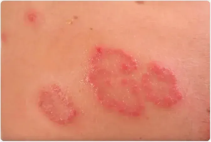 Nummular Dermatitis: Effective Strategies for Relief and Skin Health