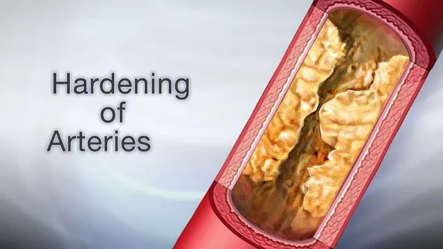 Hardening of the Arteries