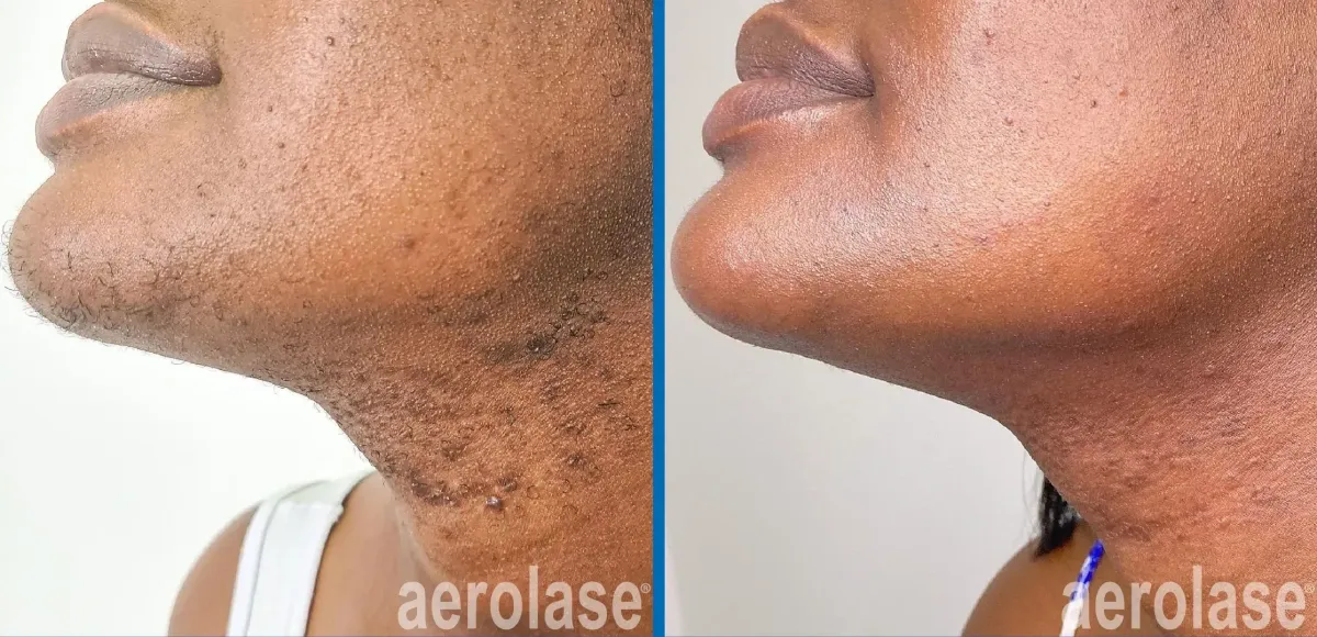 Laser Hair removal in Fishtown Pa