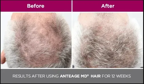 Hair Replacement Indianapolis