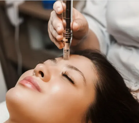 Microneedling in Indianapolis