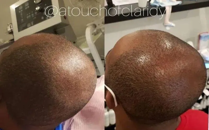 Hair Restoration Services for Indianapolis