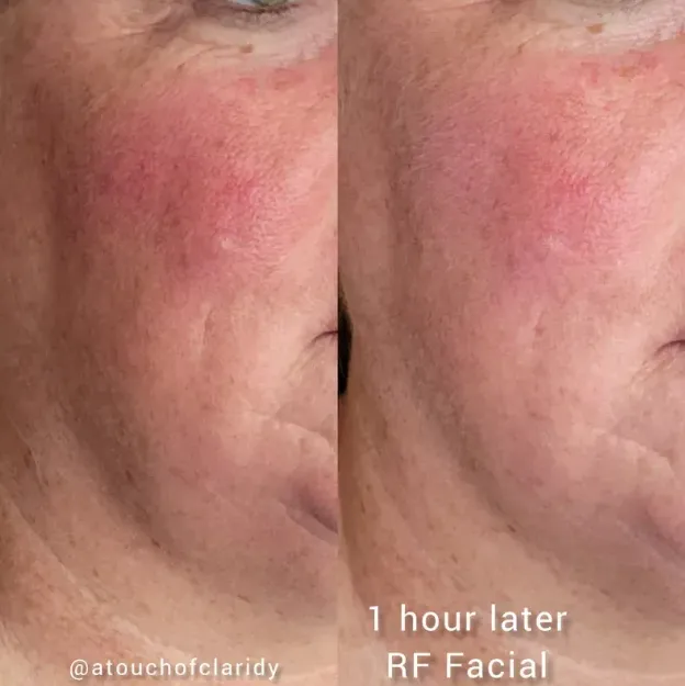 facial treatments in Indianapolis