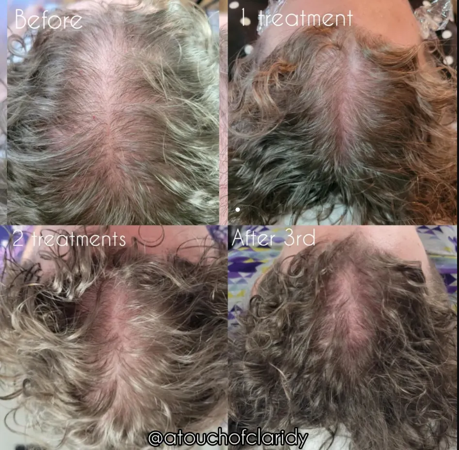 Procell Hair Treatment