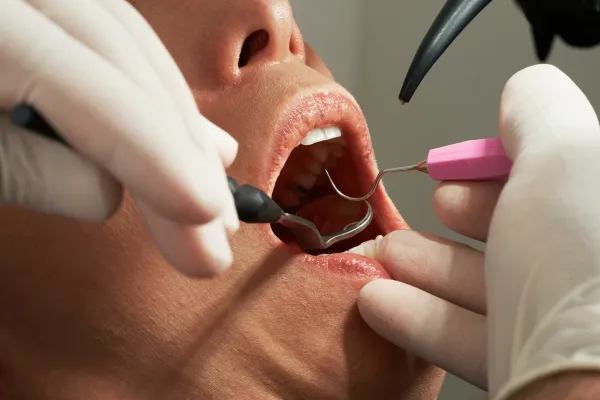 Dental Insurance: What It Covers | Mere Benefits