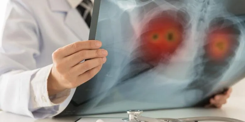 Life Insurance After Lung Cancer Diagnosis