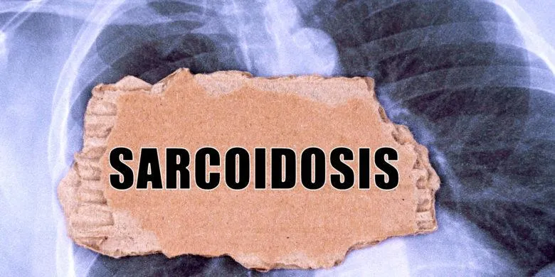 Burial insurance with Sarcoidosis: What To Know