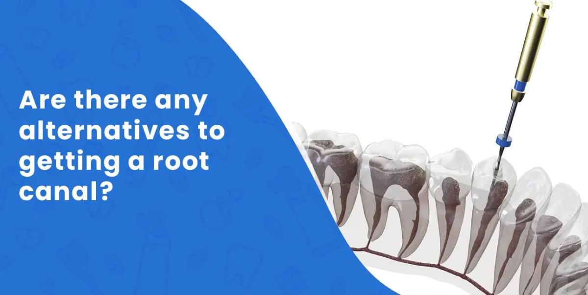 Are there any alternatives to getting a root canal?