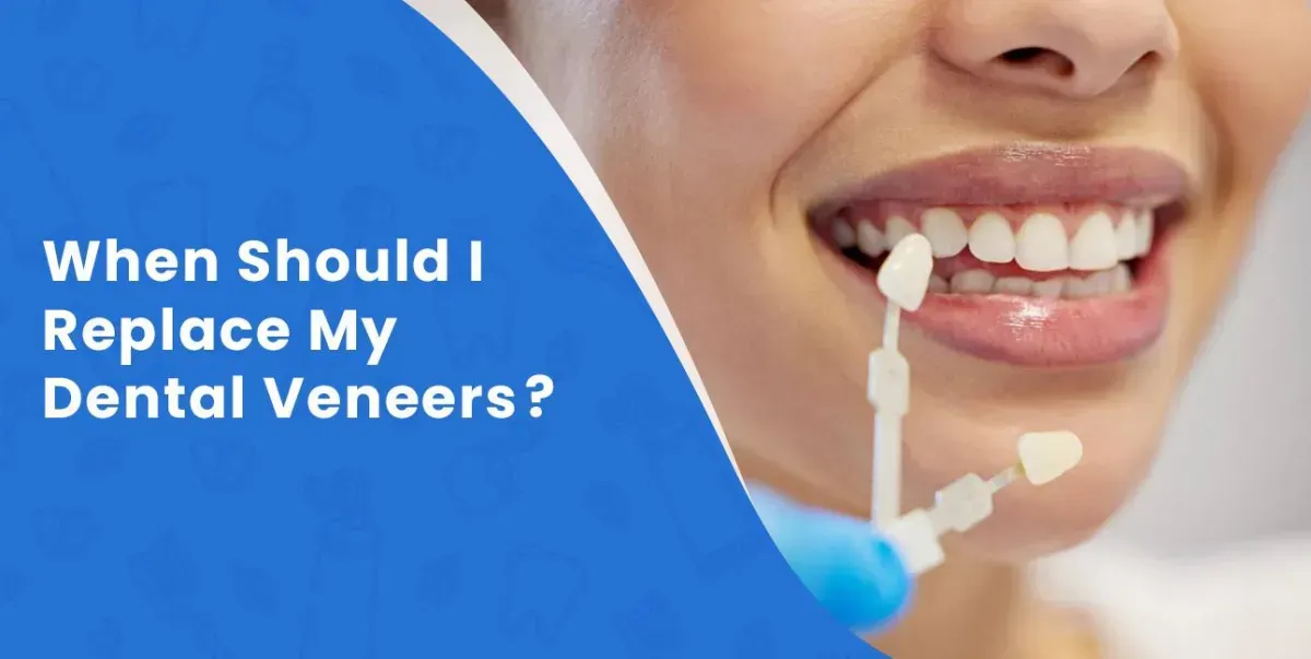 When Should I Replace My Dental Veneers?