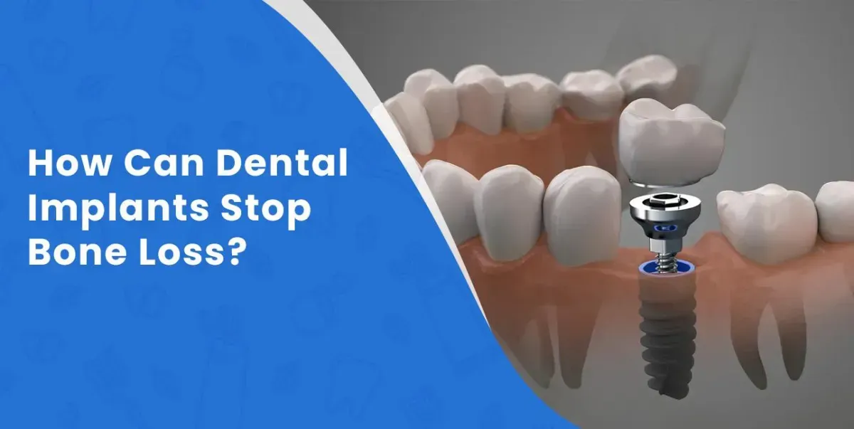 How Can Dental Implants Stop Bone Loss?