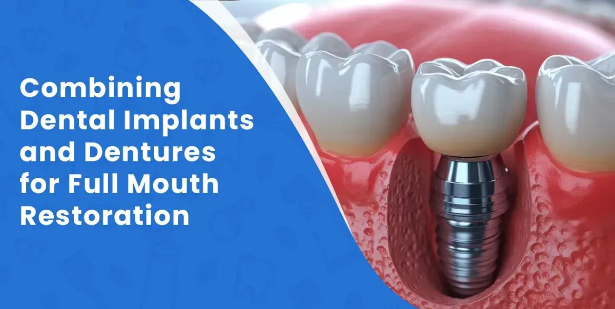Combining Dental Implants & Dentures for Full-Mouth Restoration | Sacramento, CA
