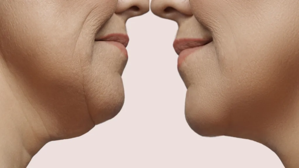 Sagging Jowls - why do they happen and what can we do about them?