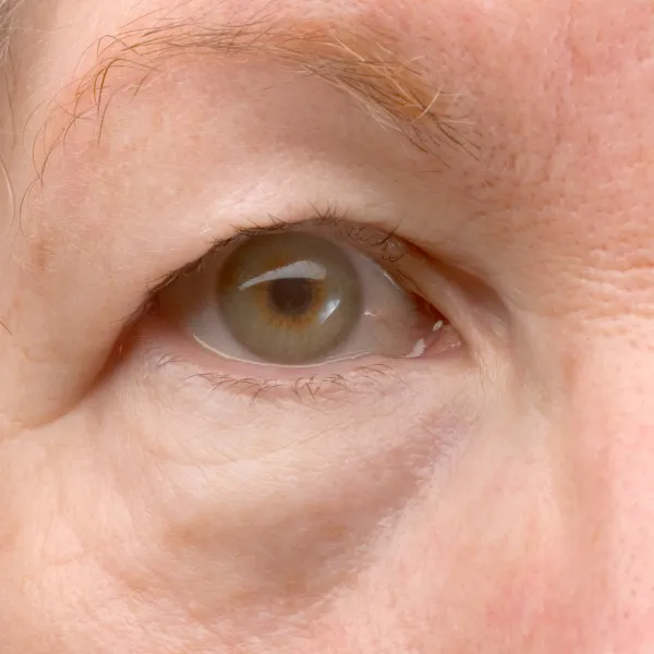 How to Hide Ptosis with Makeup