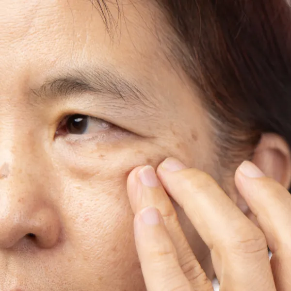 Age Spots - 3 Sure-Fire Ways to Lighten Them
