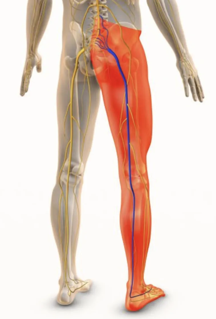Sciatica