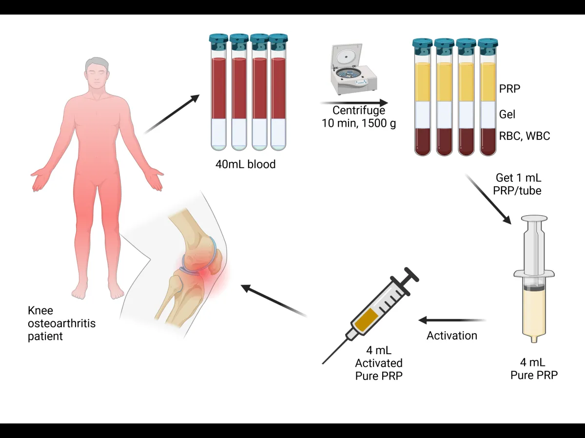 Platelet-Rich Plasma (PRP) Therapy: Regenerative Medicine Using Your Body’s Own Healing Power
