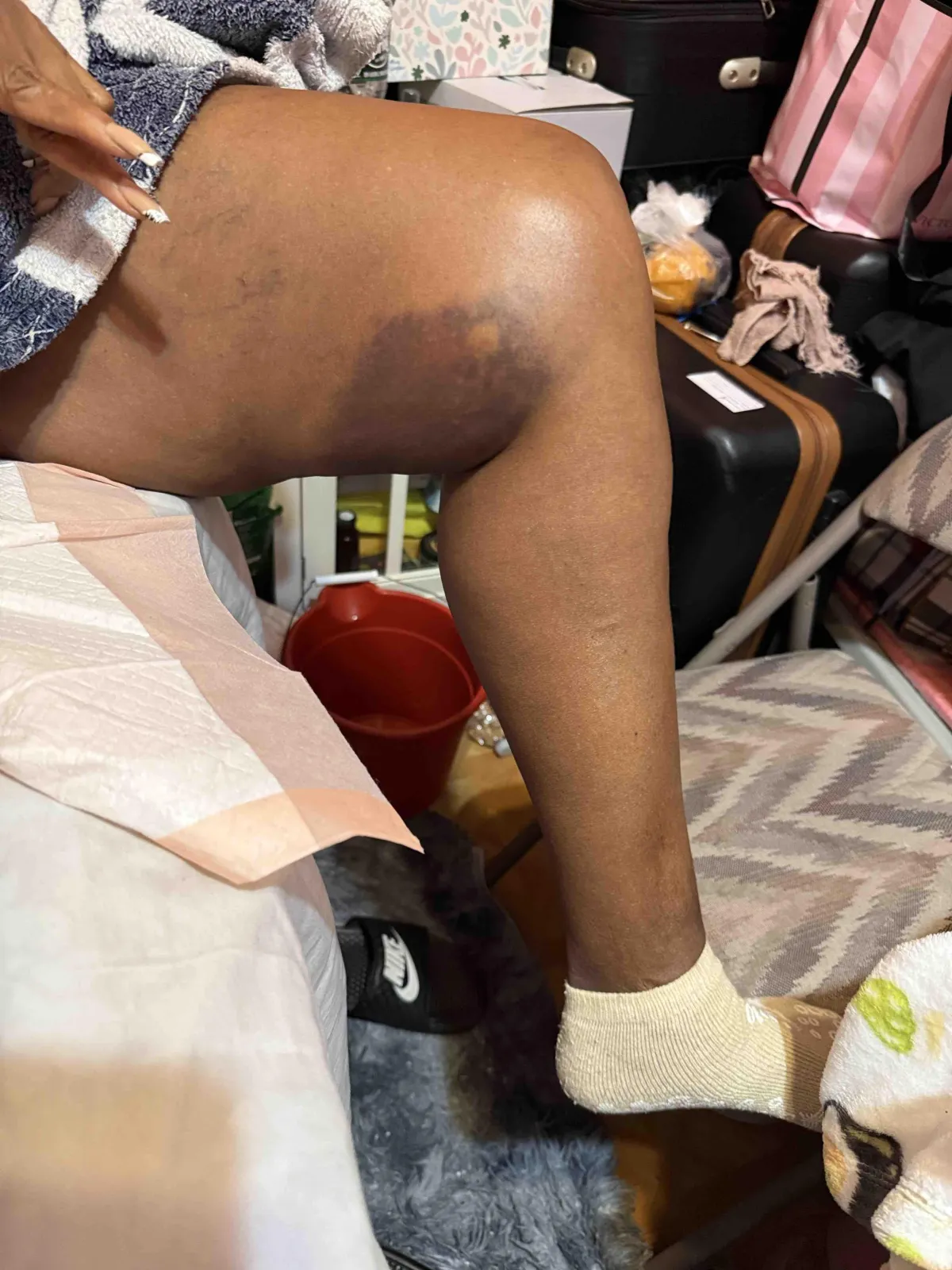 photo of a clients bruised leg from an uber accident in the bronx