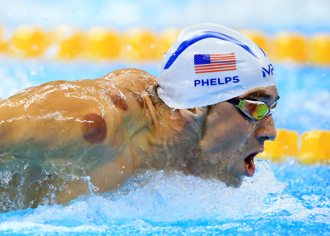 Michael Phelps, American swimmer, receiving cupping therapy treatment for sports recovery and performance enhancement