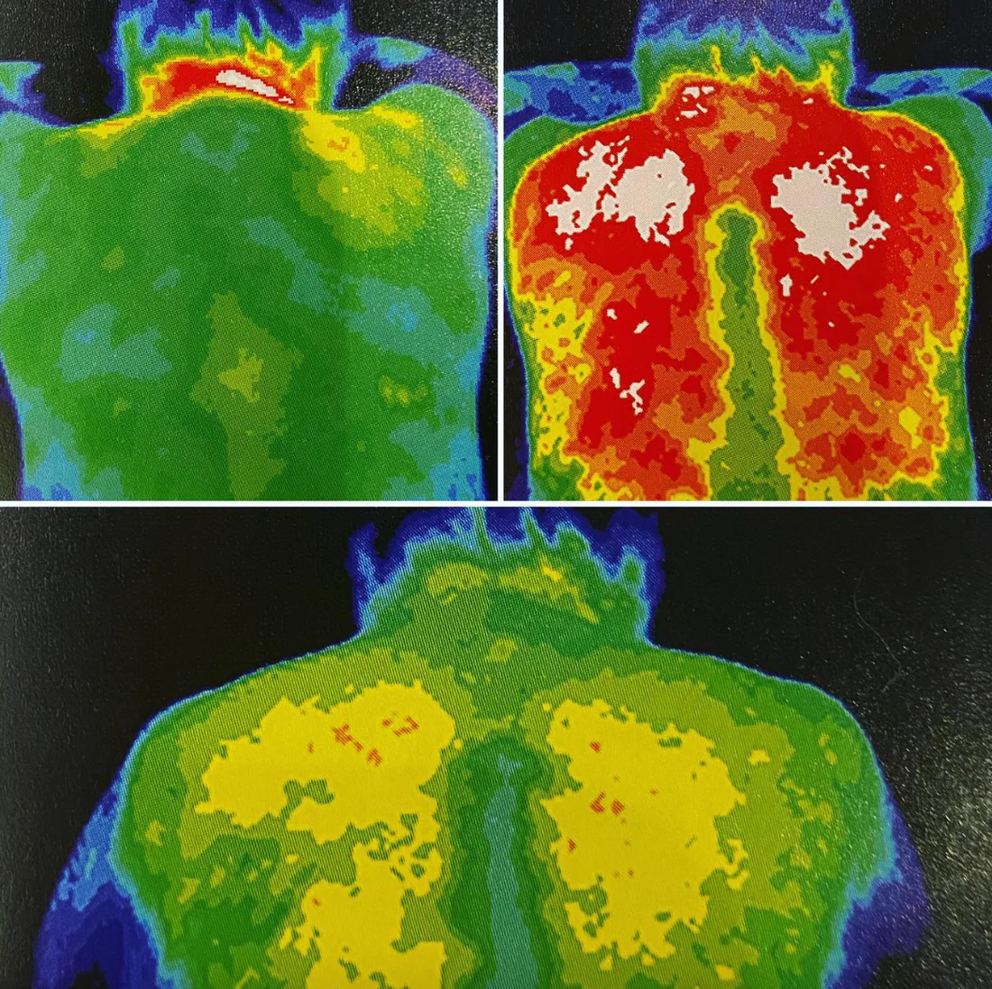 The Efficacy of Cupping Through Thermographics: Scientific Evidence