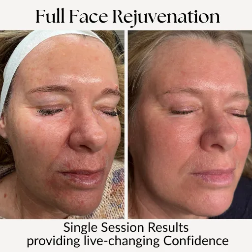 Before and After: The Power of Full Face Fibroblast Rejuvenation