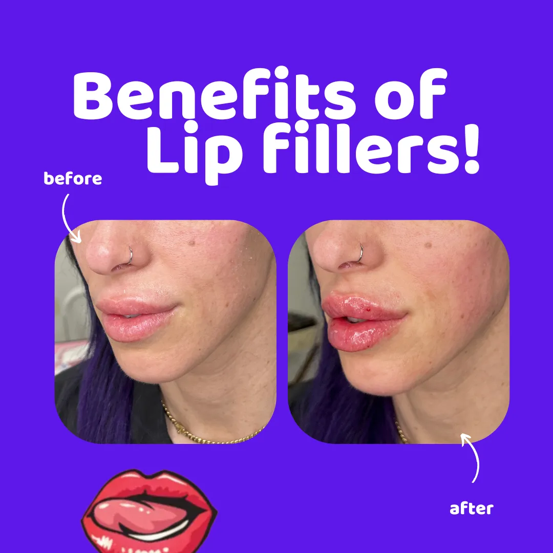 Pout Perfection at Becky Does Botox