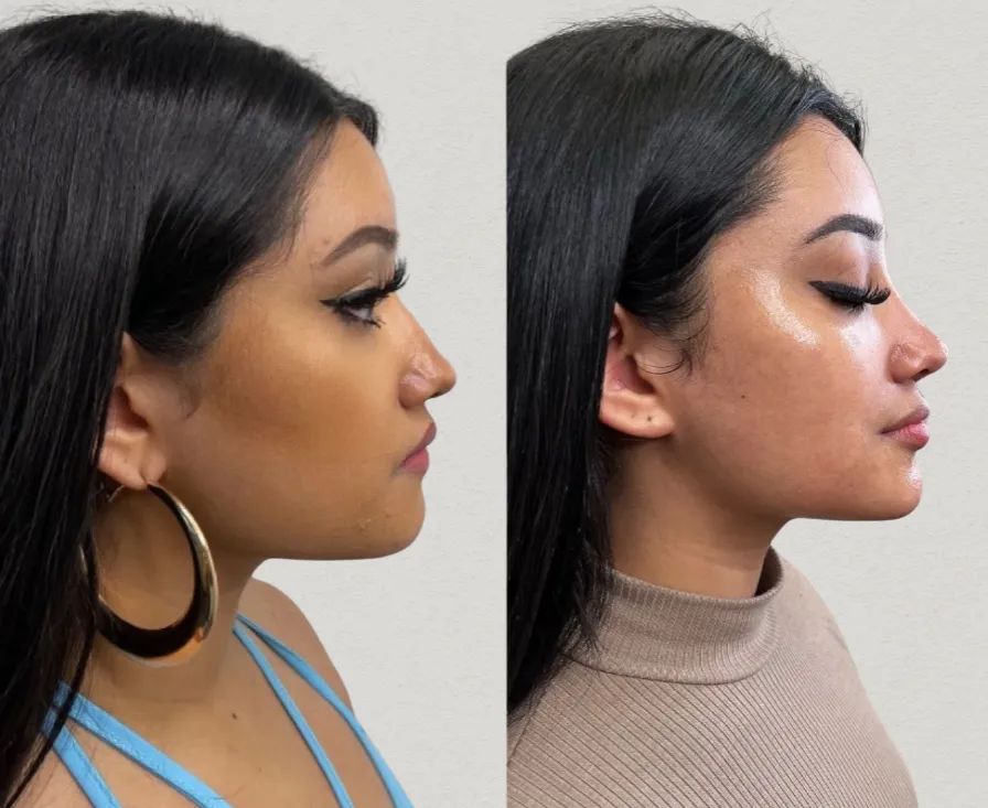 Reveal Radiant Skin with VI Peel at Polished Beauty