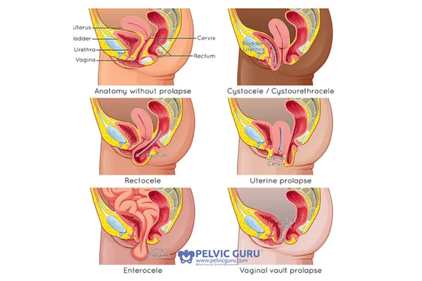 Let’s talk Pelvic Prolapse blog post cover