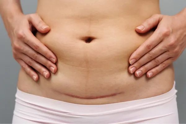 Healing After a C-Section: Physical Therapy That Supports Your Scar and Core