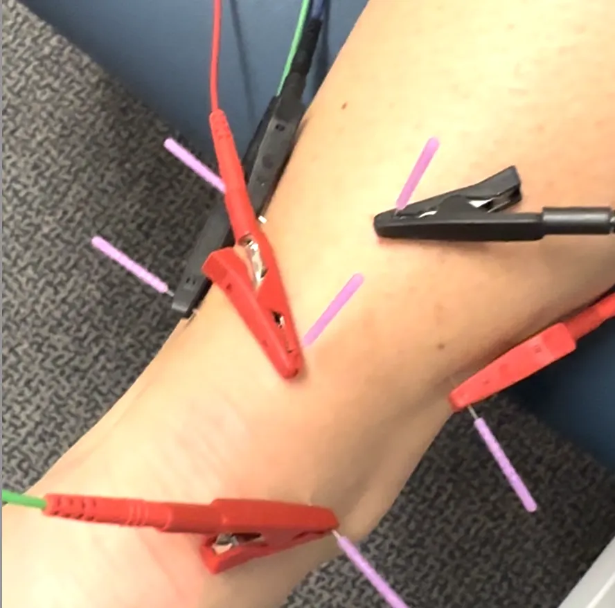 Dry Needling Achilles
