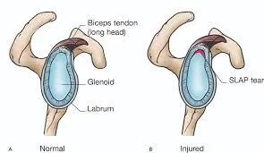 SLAP tear picture