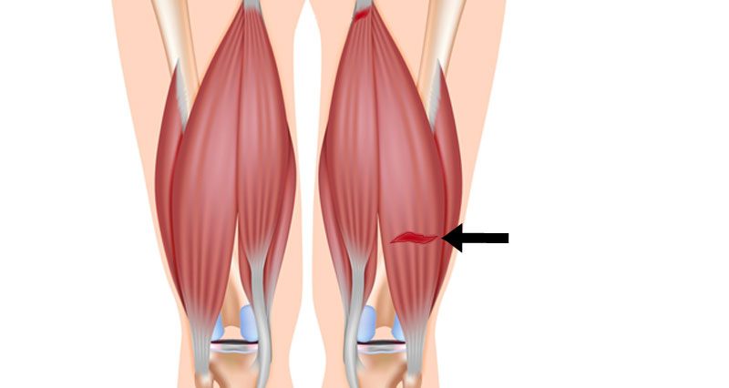 Picture of hamstring strain