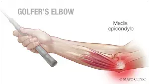 Picture of Golfer's Elbow anatomy