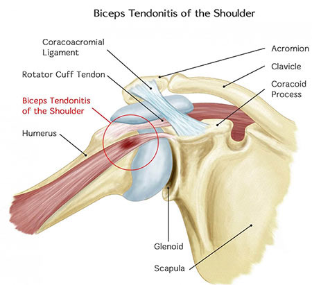 Anterior Shoulder Pain in Pitchers: Why It Happens & How We Fix It