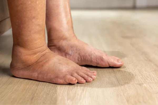 How the Apex Laser Enhances Circulation in Cold, Ischaemic Feet