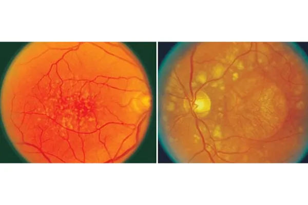 xclusive Editions and Special Topics of the Macular Program