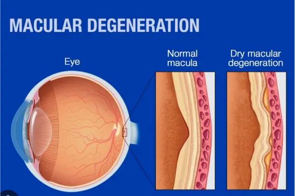 Stages of Dry AMD