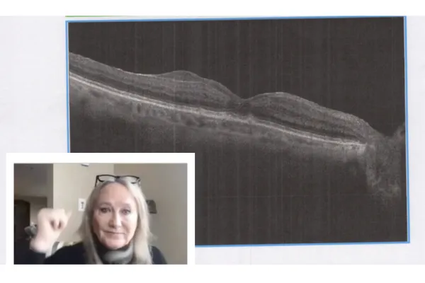 a high-resolution OCT (Optical Coherence Tomography) scan of an eye, showing detailed retinal layers; on the bottom, a woman with blonde hair and glasses making a fist gesture, with a neutral expression.