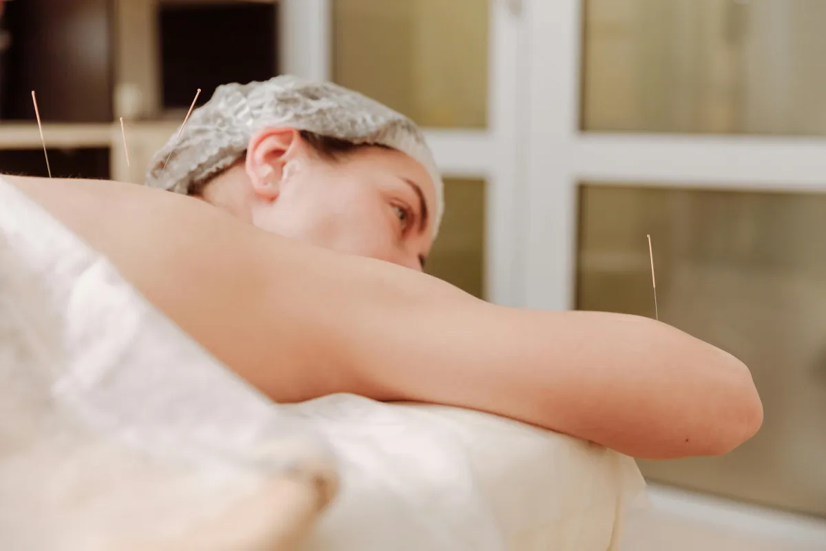 acupuncture