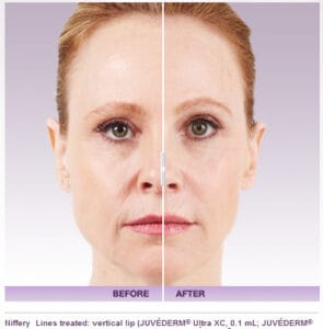 Juvederm Facial Filler Before And After Photos