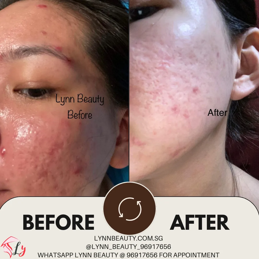 Lynn Beauty Facial