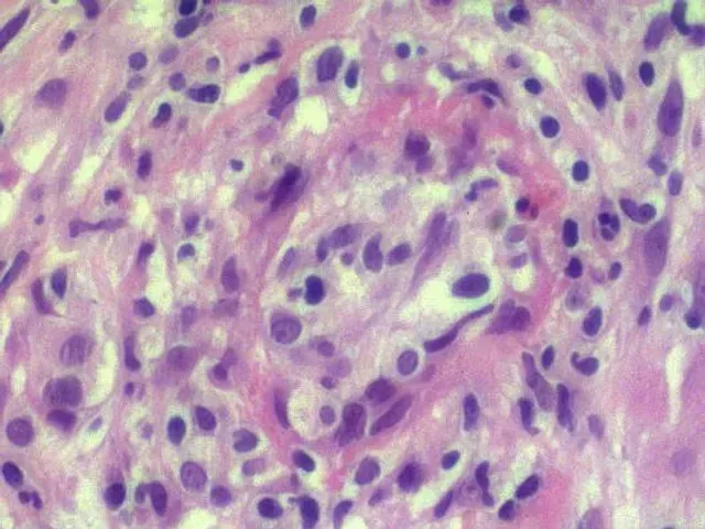 Lyme Coinfection Series: Q Fever